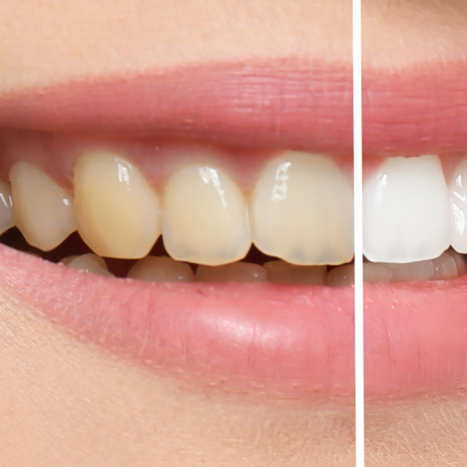 Imagen descriptiva de Estética Dental