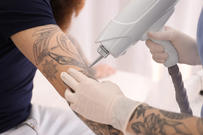 Imagen sobre Eliminación de tatuajes
